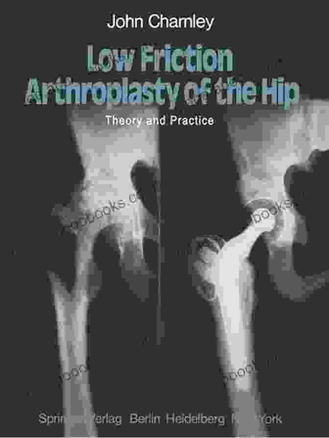 An Illustration Of John Charnley's Low Friction Arthroplasty, Which Involved Replacing The Damaged Hip Joint With A Metal On Plastic Prosthesis. John Charnley: The Man And The Hip