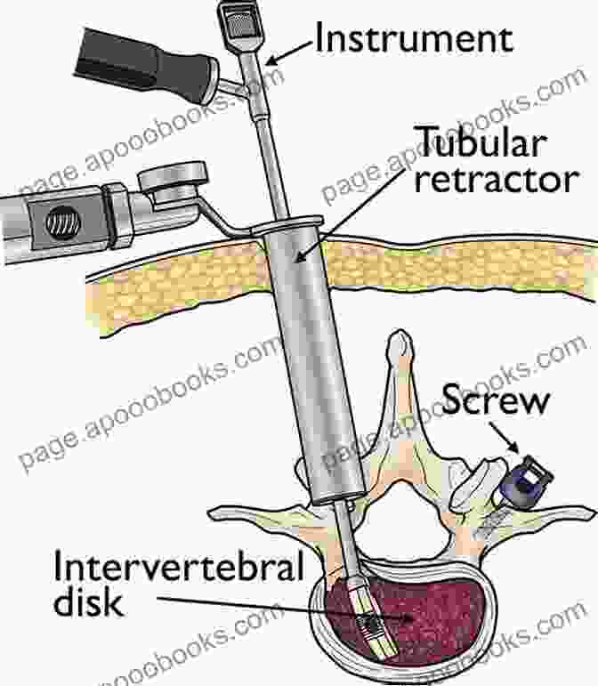 Minimally Invasive Spine Surgery Surgical Approaches To The Spine