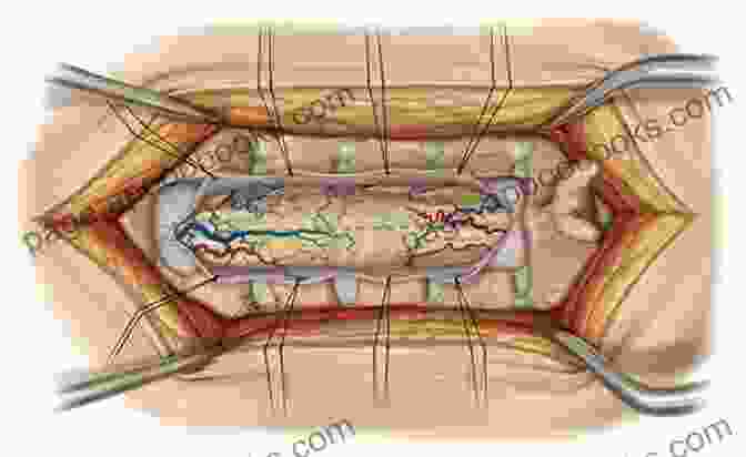 Spinal Cord Tumor Resection Surgical Approaches To The Spine