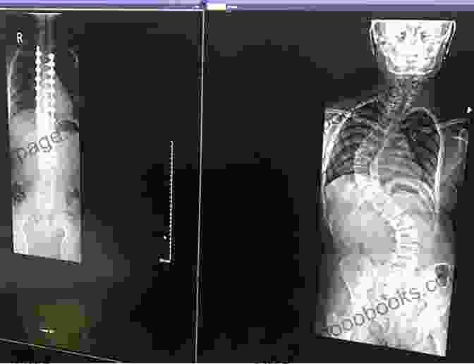 Spinal Deformity Correction Surgical Approaches To The Spine