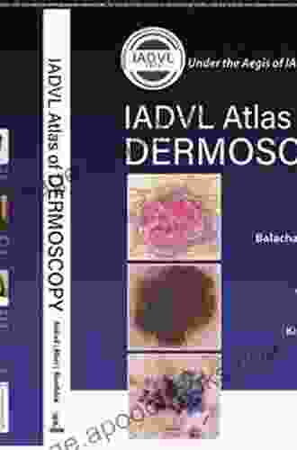 An Atlas Of Dermoscopy Murali Thondebhavi