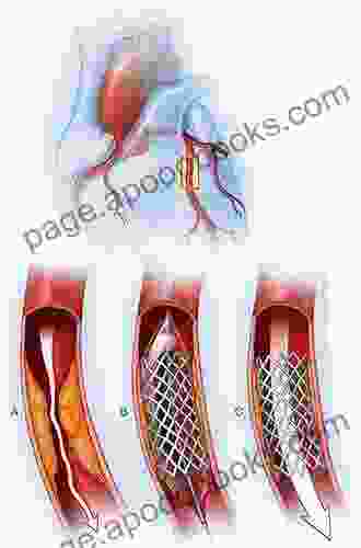 Coronary Stents Michael Meisner